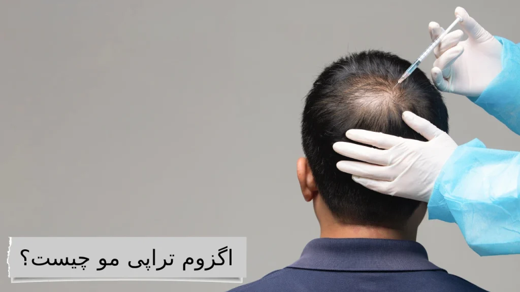 اگزوم تراپی مو چیست؟ بهترین کلینیک ها برای اگزوم تراپی مو با قیمت مناسب