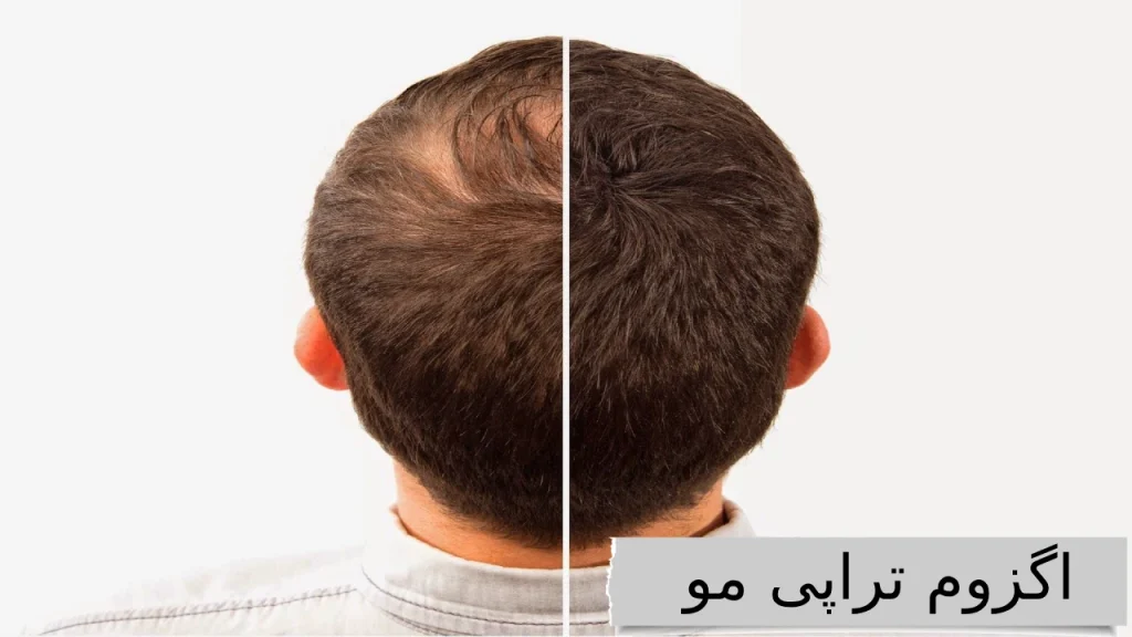بهترین کلینیک ها برای اگزوم تراپی مو با قیمت مناسب