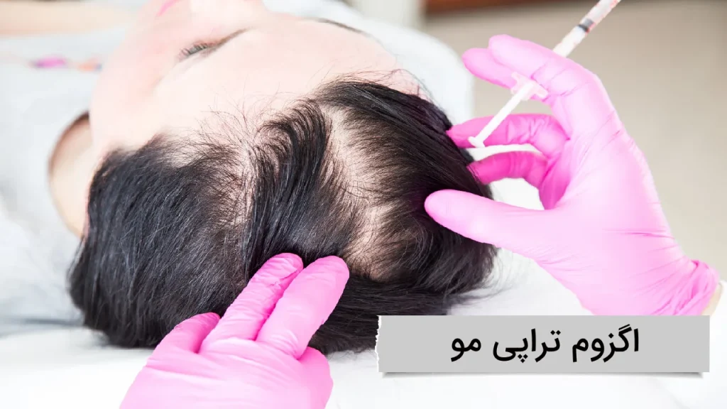 اگزوم تراپی مو در تهران