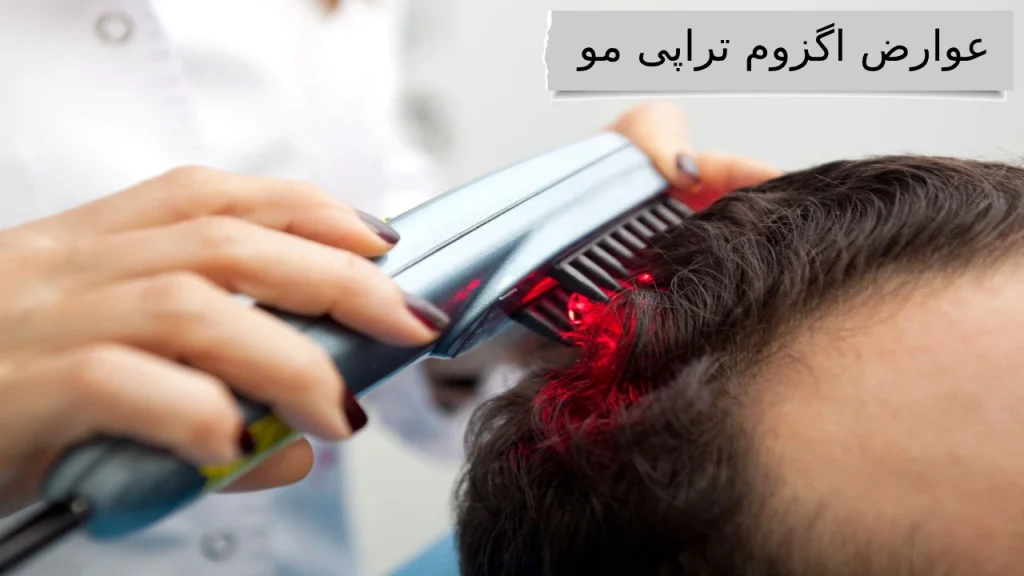 عوارض اگزوم تراپی مو بهترین کلینیک ها برای اگزوم تراپی مو با قیمت مناسب