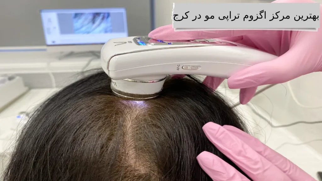بهترین مرکز اگزوم تراپی مو در کرج بهترین کلینیک ها برای اگزوم تراپی مو با قیمت مناسب