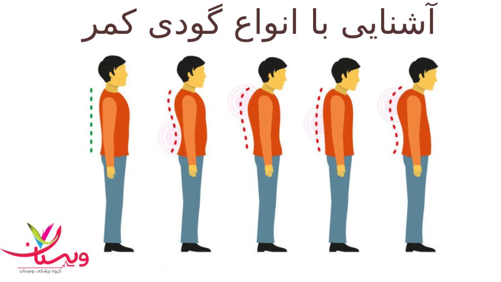 گودی کمر و گردن تصویر مربوط به انواع مدل های گودی کمر و گردن