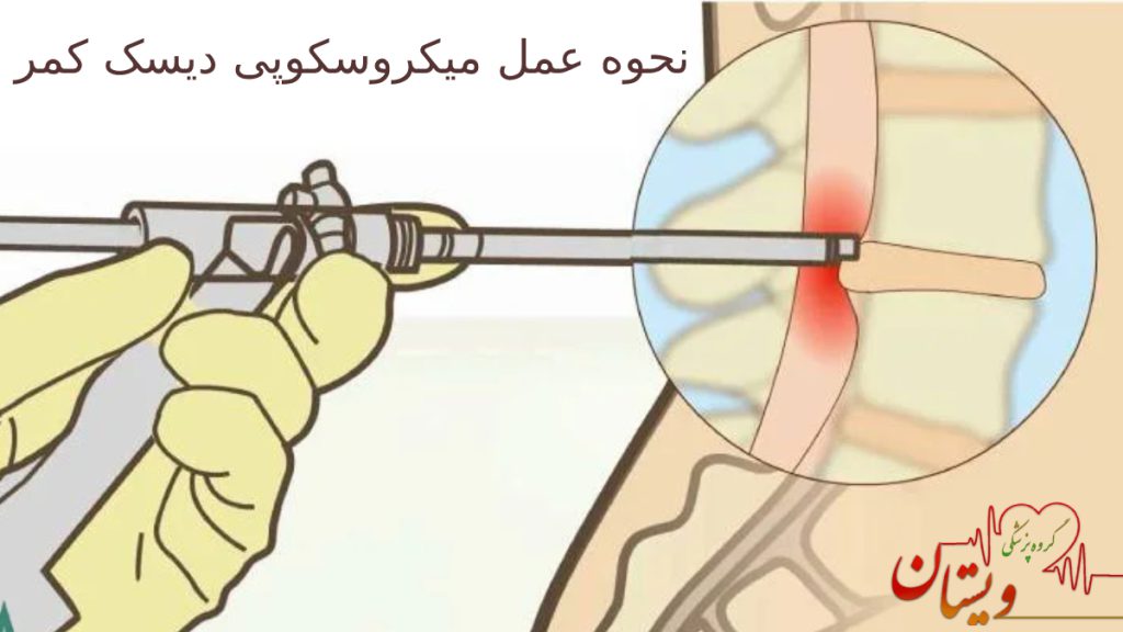 نحوه انجام عمل میکروسکوپی دیسک کمر 