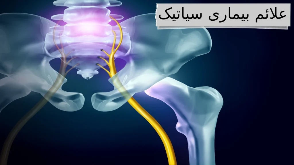 علائم بیماری سیاتیک آشنایی و رهایی از ذرد مزمن بیماری سیاتیک