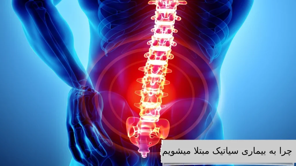 چرا به بیماری سیاتیک مبتلا میشویم آشنایی و رهایی از ذرد مزمن بیماری سیاتیک