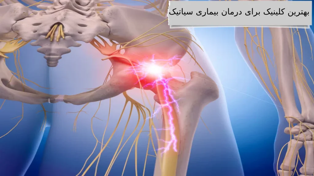 بهترین کلینیک برای درمان بیماری سیاتیک آشنایی و رهایی از ذرد مزمن بیماری سیاتیک