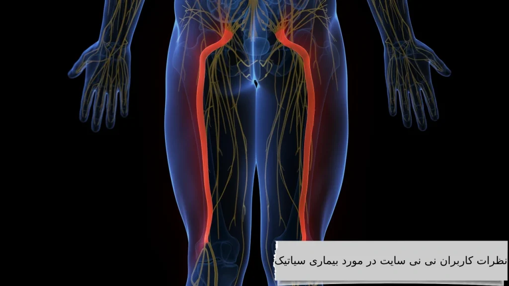 نظرات کاربران نی نی سایت در مورد بیماری سیاتیک آشنایی و رهایی از ذرد مزمن بیماری سیاتیک