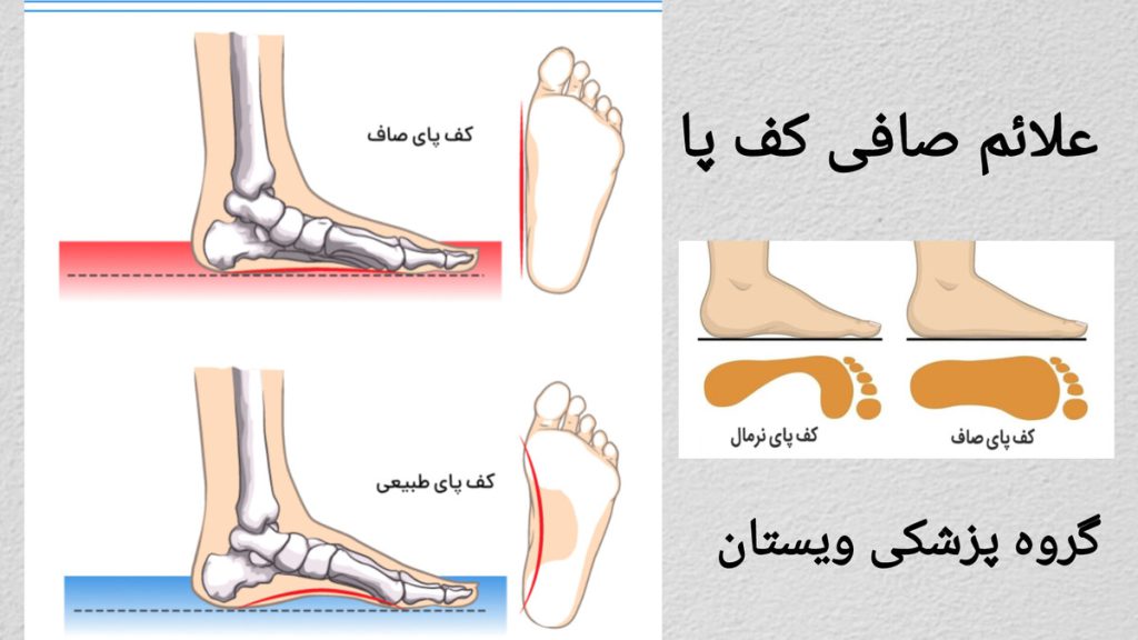 علائم صافی کف پا و درمان به موقع مقایسه کف پای طبیعی و کف پای صاف