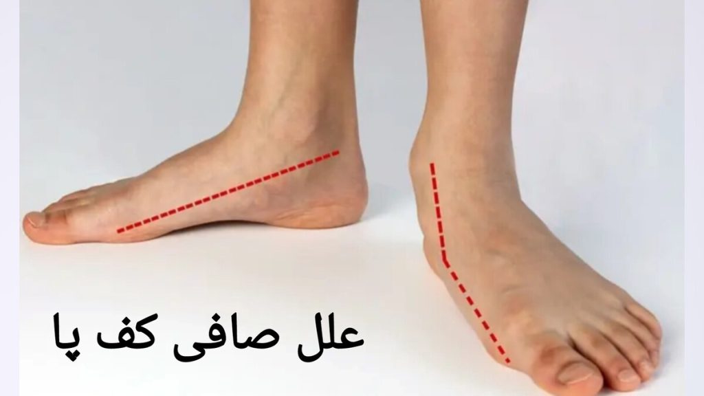 علل ایجاد صافی کف پا در افراد پاهای فردی که صافی کف پا دارد