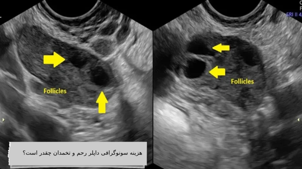 هزینه سونوگرافی داپلر رحم و تخمدان چقدر است؟ هزینه سونوگرافی داپلر رحم و تخمدان چقدر است؟