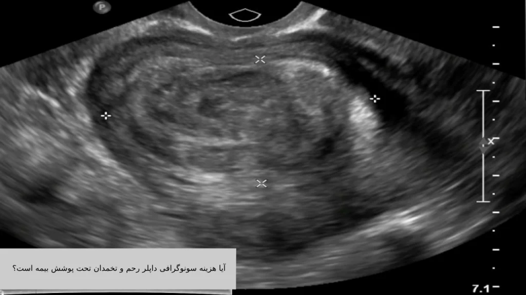 آیا هزینه سونوگرافی داپلر رحم و تخمدان تحت پوشش بیمه است؟ آیا هزینه سونوگرافی داپلر رحم و تخمدان تحت پوشش بیمه است؟