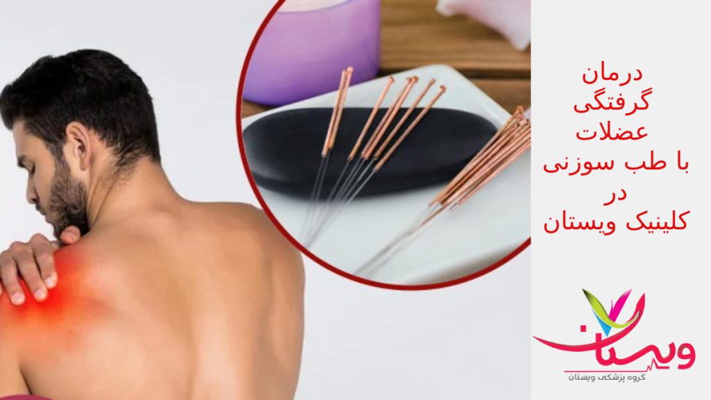 طب-سوزنی-برای-اسپاسم-عضلانی درمان گرفتگی عضلات با طب سوزنی