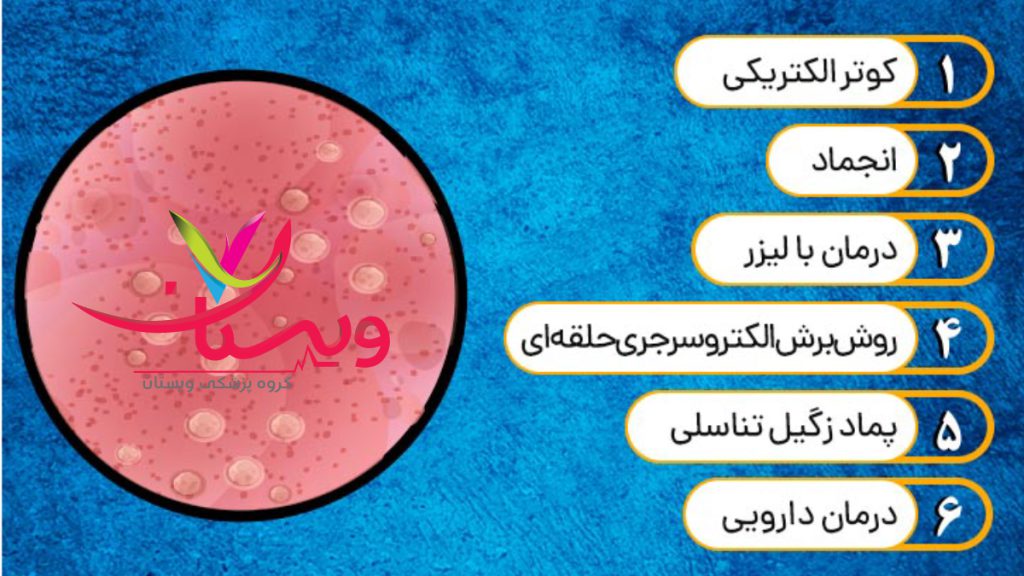 hpv treatment نحوه درمان اچ پی وی یا زگیل تناسلی