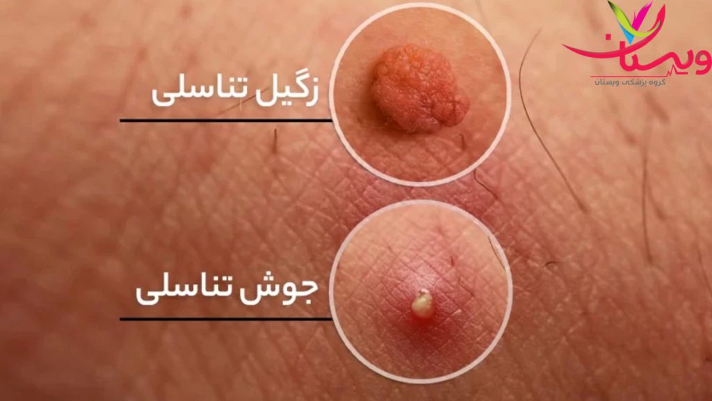 زگیل و جوش جوش و زگیل تناسلی چه فرقی دارد