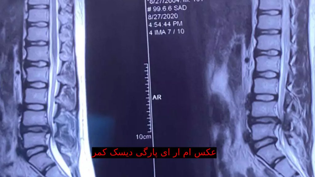 پارگی دیسک کمر عکس مربوط به ام ار ای دیسک کمر