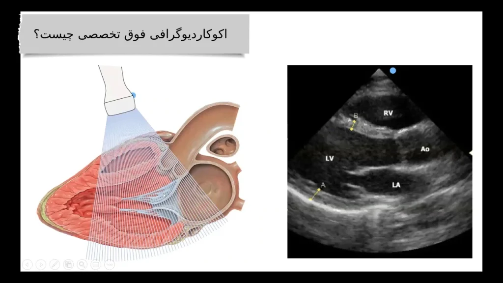 اکوکاردیوگرافی فوق تخصصی چیست؟