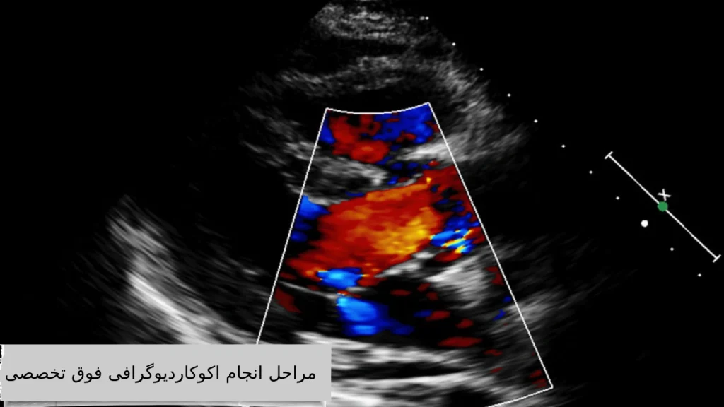 مراحل انجام اکوکاردیوگرافی فوق تخصصی 
