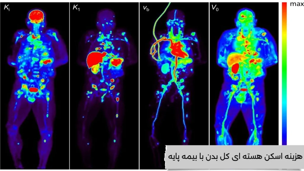 هزینه اسکن هسته ای کل بدن با بیمه پایه از هزینه اسکن هسته ای کل بدن با بیمه پایه چقدر میدانید؟؟