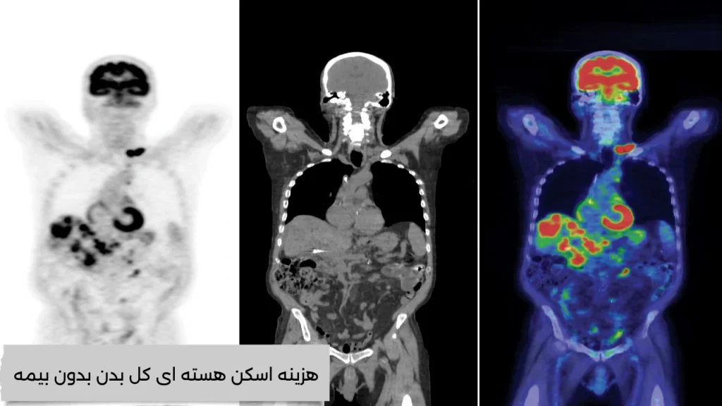 هزینه اسکن هسته ای کل بدن بدون بیمه ایا از هزینه اسکن هسته ای کل بدن بدون بیمه خبر دارید؟؟