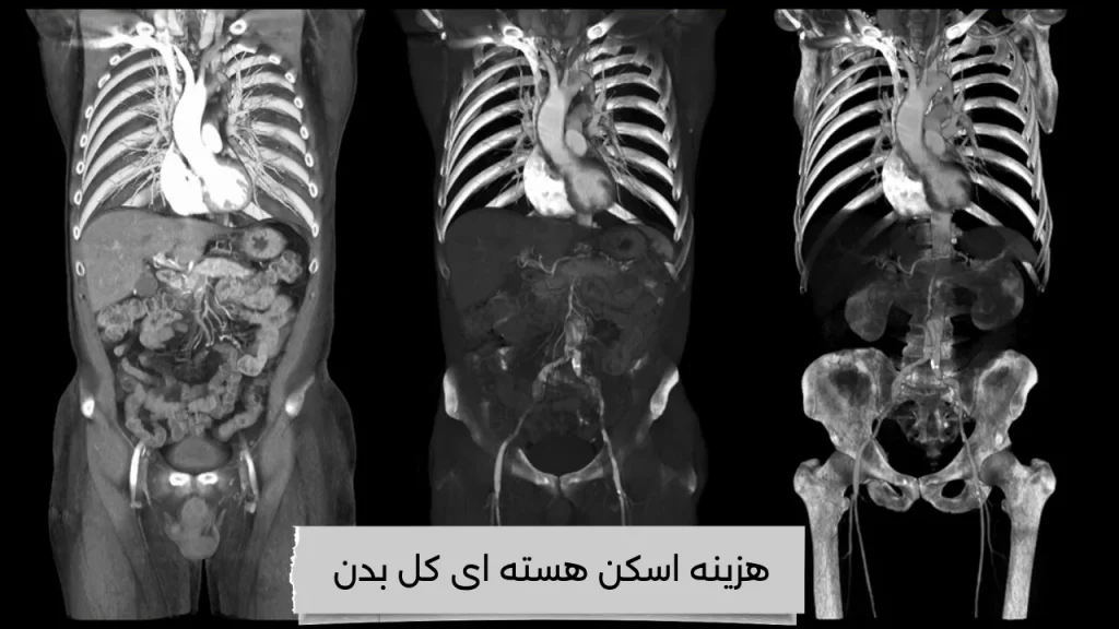 هزینه اسکن هسته ای کل بدن