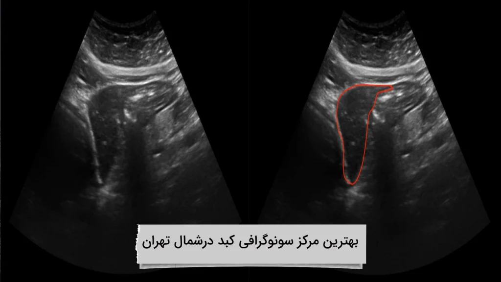 بهترین مرکز سونوگرافی کبد درشمال تهران کلینیک ویستان در شمال تهران
