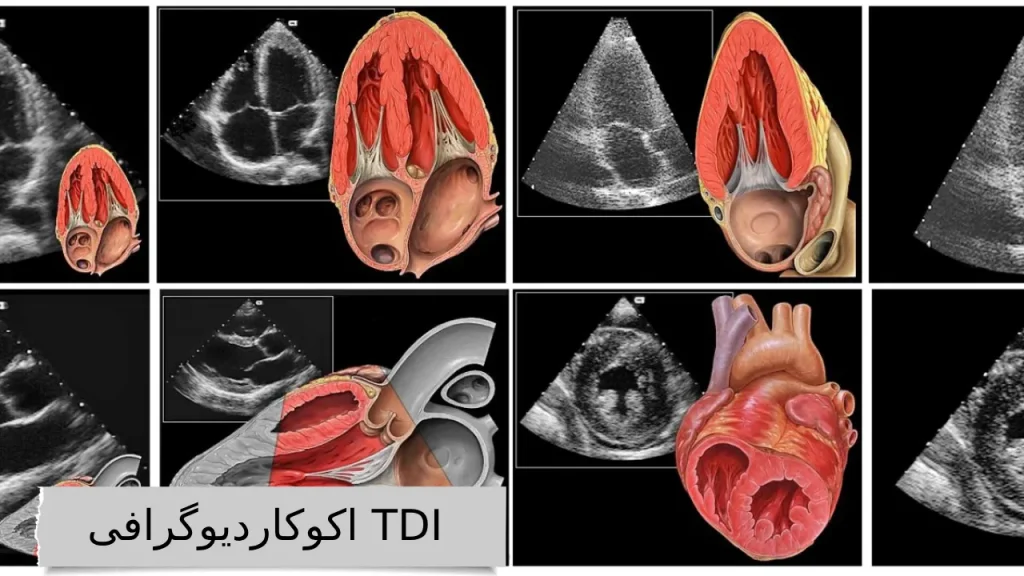 اکوکاردیوگرافی TDI