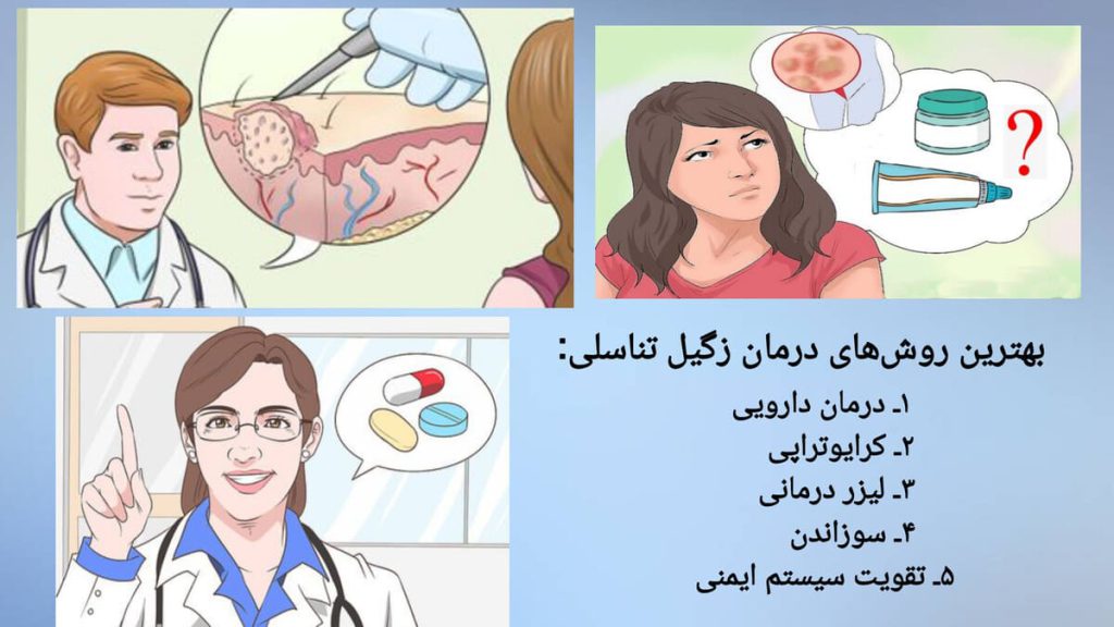 درمان های موثر برای زگیل تناسلی