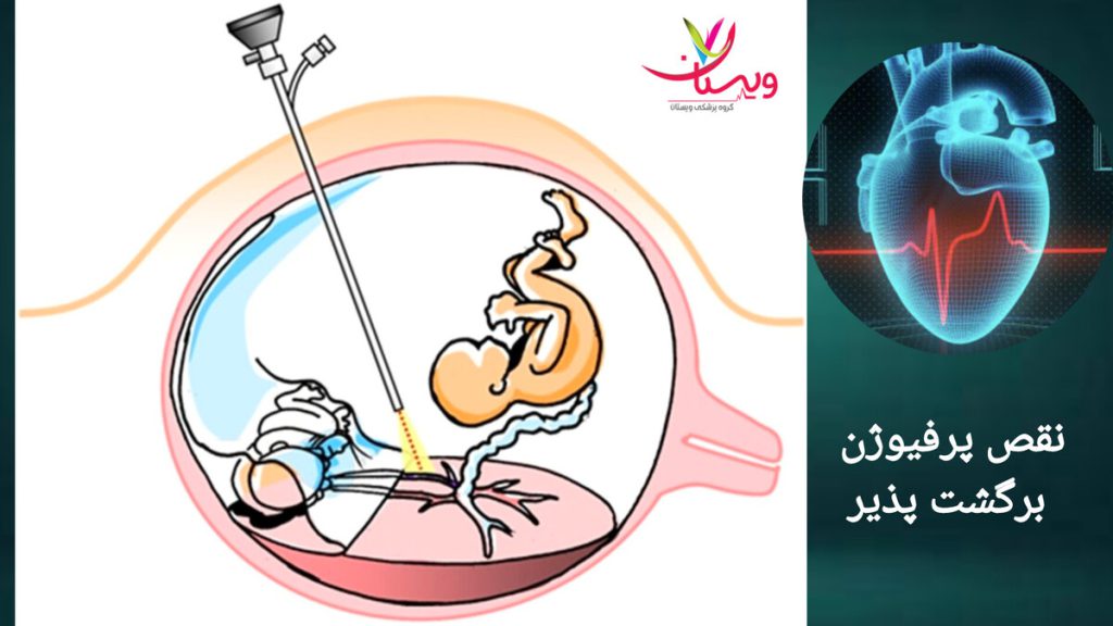 نمایی از نقص پرفیوژن برگشت پذیر نمایی از حالت نقص پرفیوژن برگشت پذیر در جنین