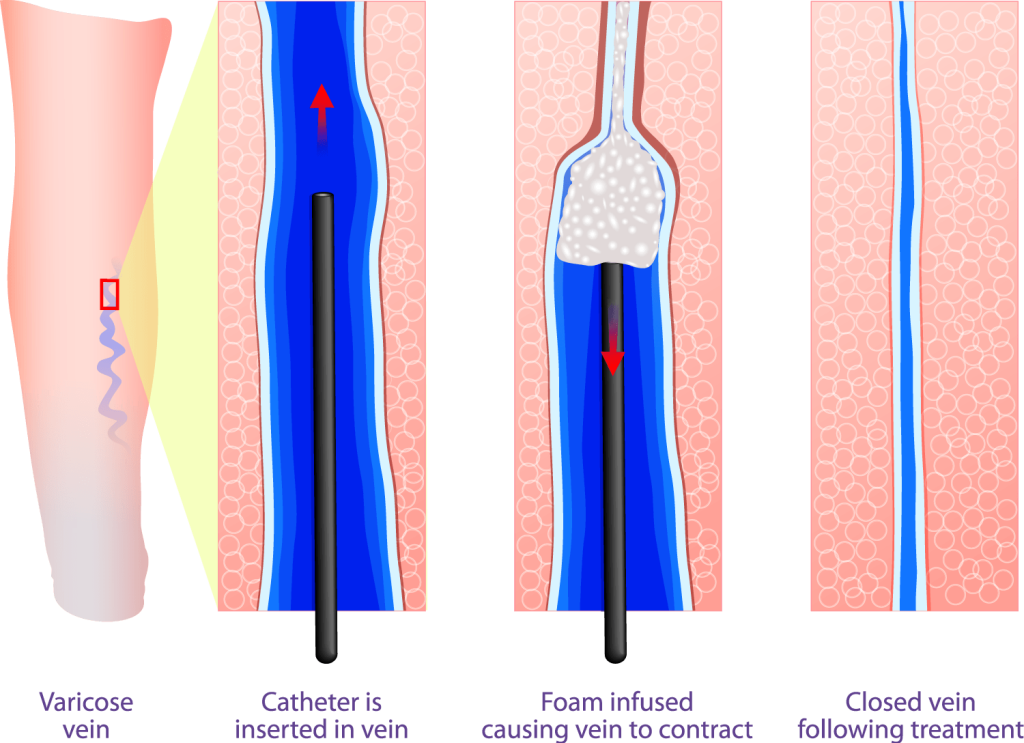 vein sclrotherapy تصویر انیمیشنی مربوط به اسکلروتراپی واریس پا