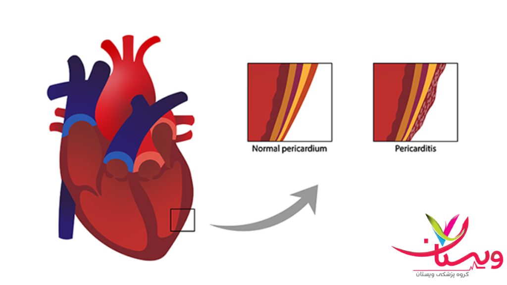pericarditis تصویر انیمیشنی از تفاوت بین پریکارد نرمال قلب و بروز پریکاردیت در قلب