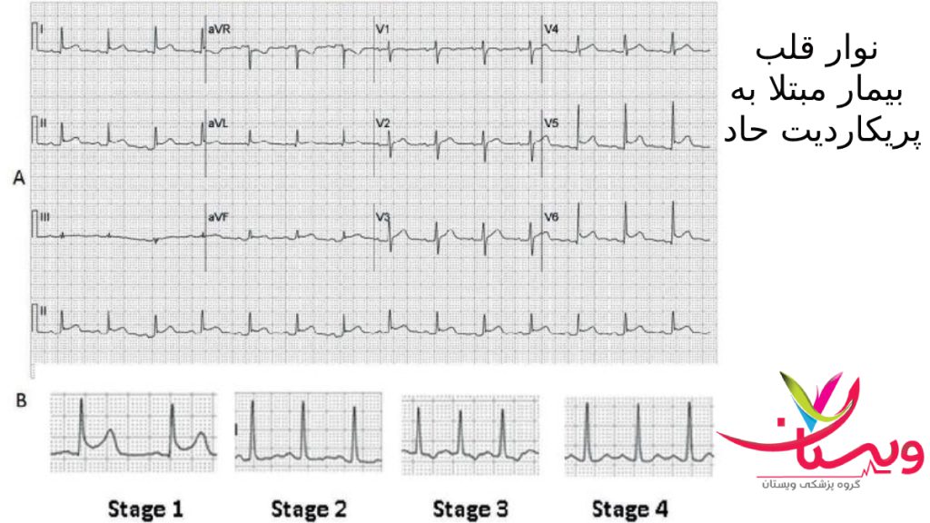 acute pericardit تصویری از نوارد قلب بیمار مبتلا به پریکاردیت حاد
