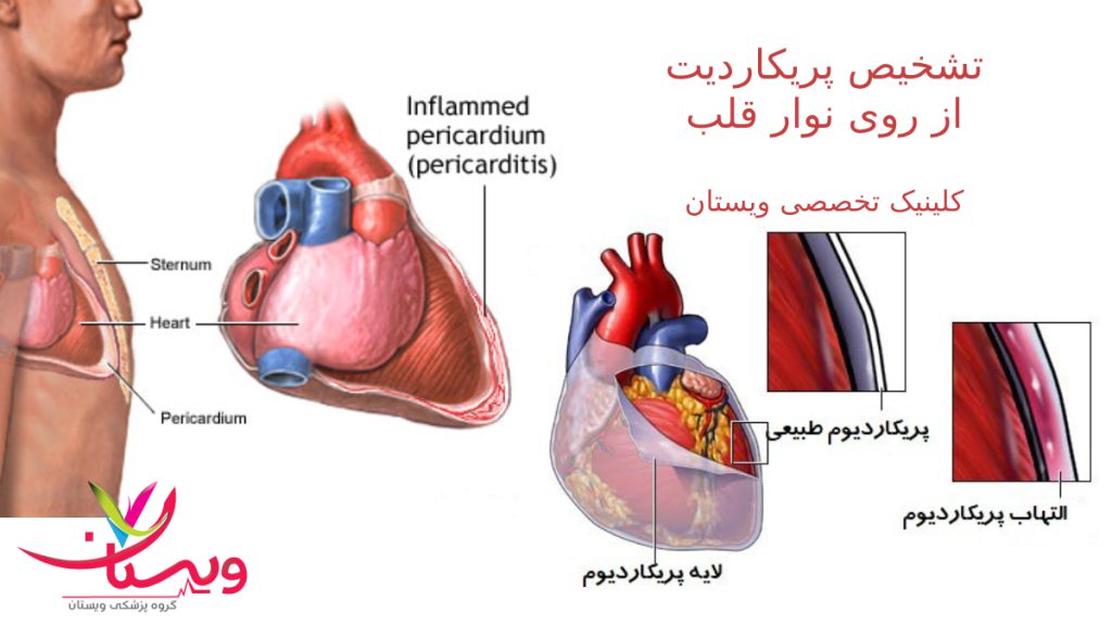 پریکاردیت چیست و چطور از روی نوارد قلب می توان آن را تشخیص داد؟