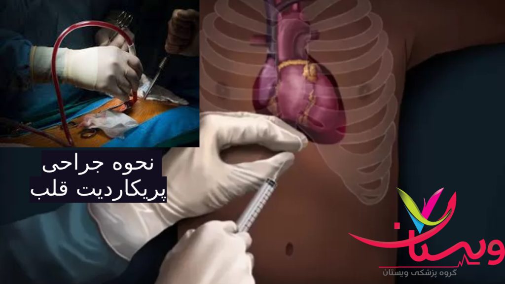جراحی پریکاردیت عکسی از نحوه تحلیه مایع دور پریکارد قلب و نحوه جراحی پریکاردیت