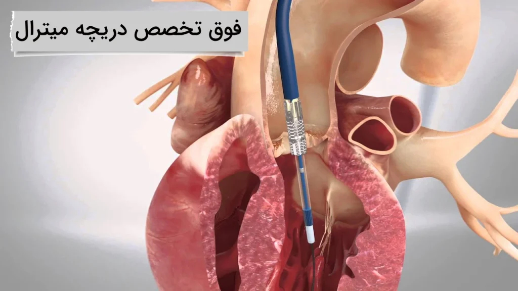 فوق تخصص دریچه میترال قلب
