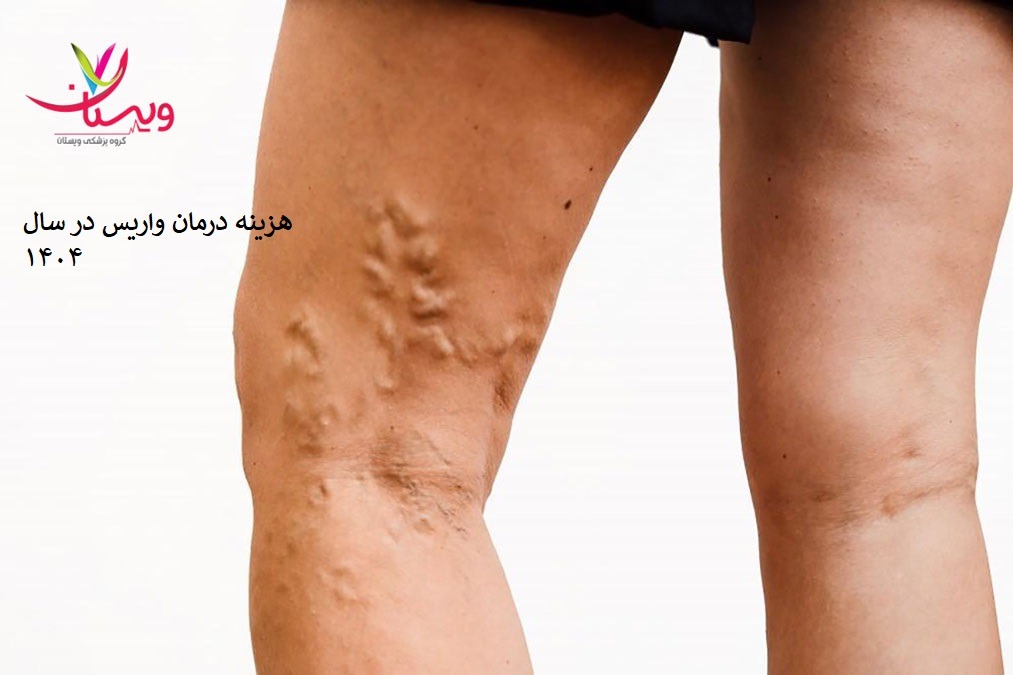 هزینه درمان واریس