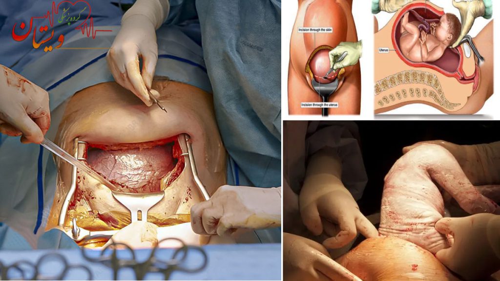 عکس جراحی سزارین واقعی تصاویری از جراحی واقعی سزارین