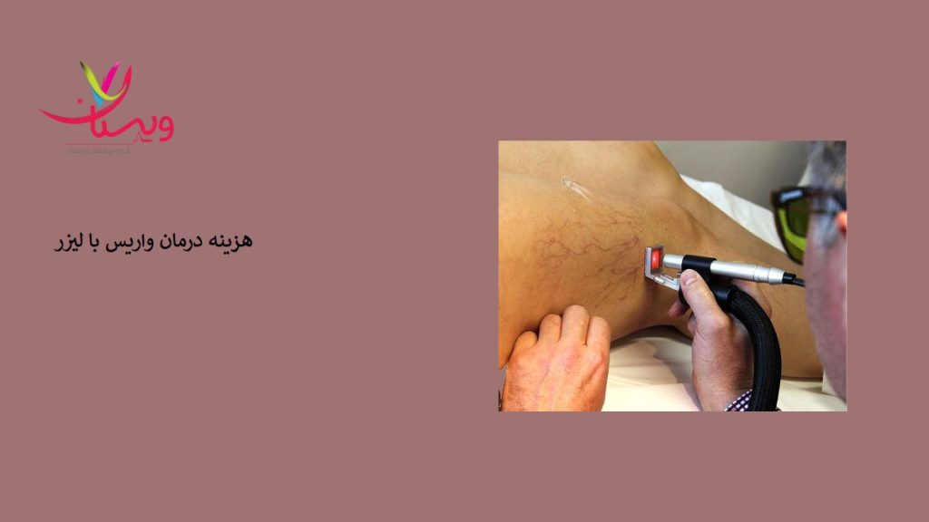 هزینه درماان واریس پا با لیزر