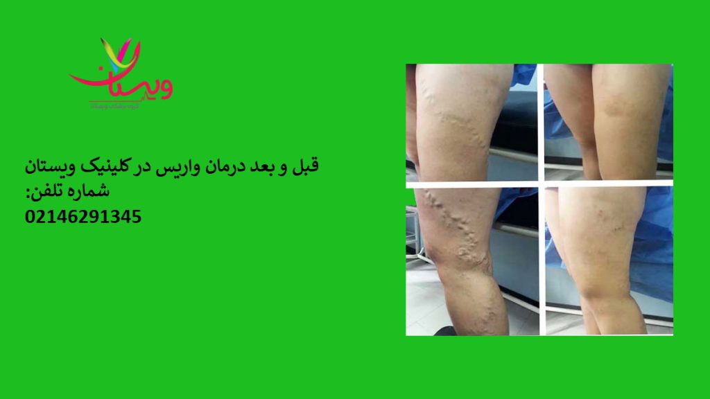 قبل و بعد درمان واریس