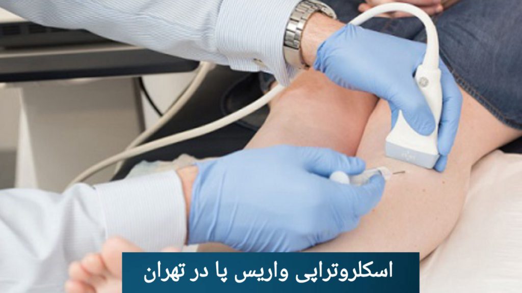 انجام اسکلروتراپی در کلینیک تخصصی ویستان انجام اسکلروتراپی برای درمان واریس پا در گروه پزشکی ویستان