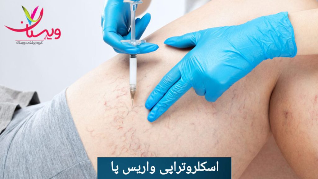 رفع رگ های واریسی توسط پزشک با اسکلروتراپی انجام اسکلروتراپی برای درمان رگهای واریسی توسط پزشک
