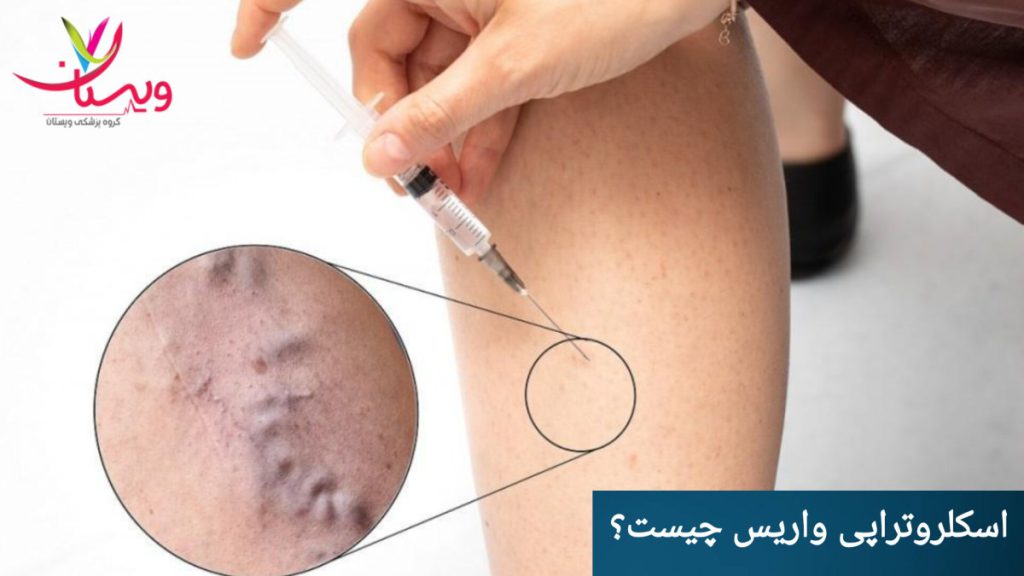 انجام اسکلروتراپی برای واریس پا و رفع رگ های عنکبوتی نمایی از رگ های عنکبوتی و انجام اسکلروتراپی برای واریس پا