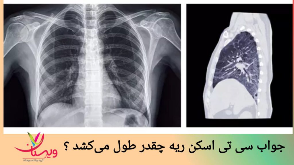تصویر ریه بیمار تصویری از ریه بیمار نشان داده می شود