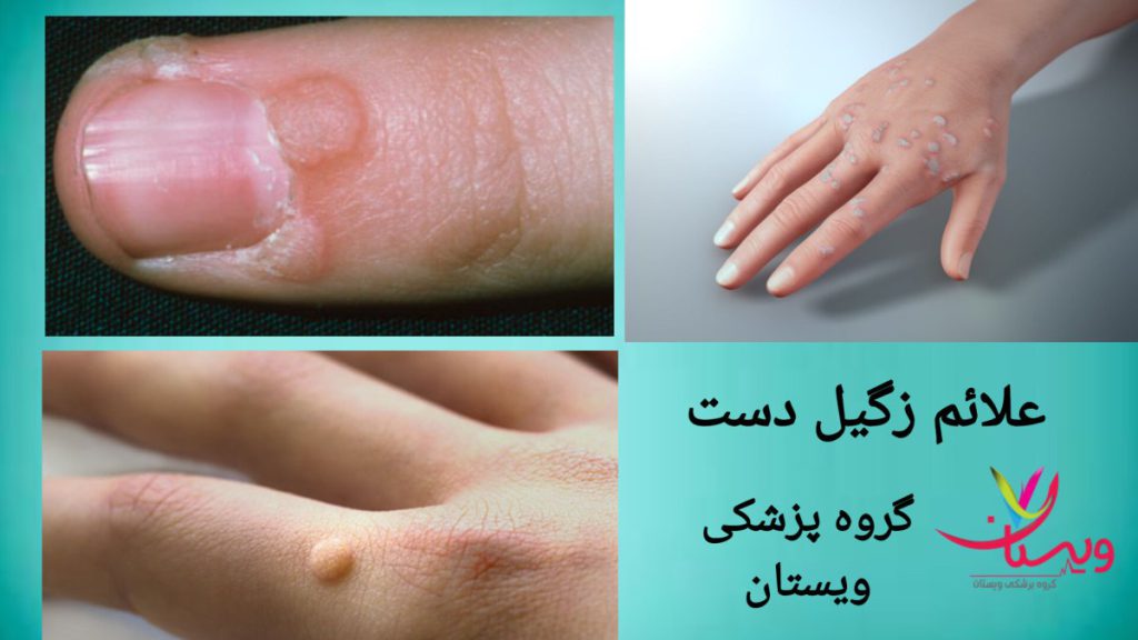مشاهده بعضی از علائم از زگیل روی دست بیمار علائمی از ایجاد زگیل روی انگشت فرد