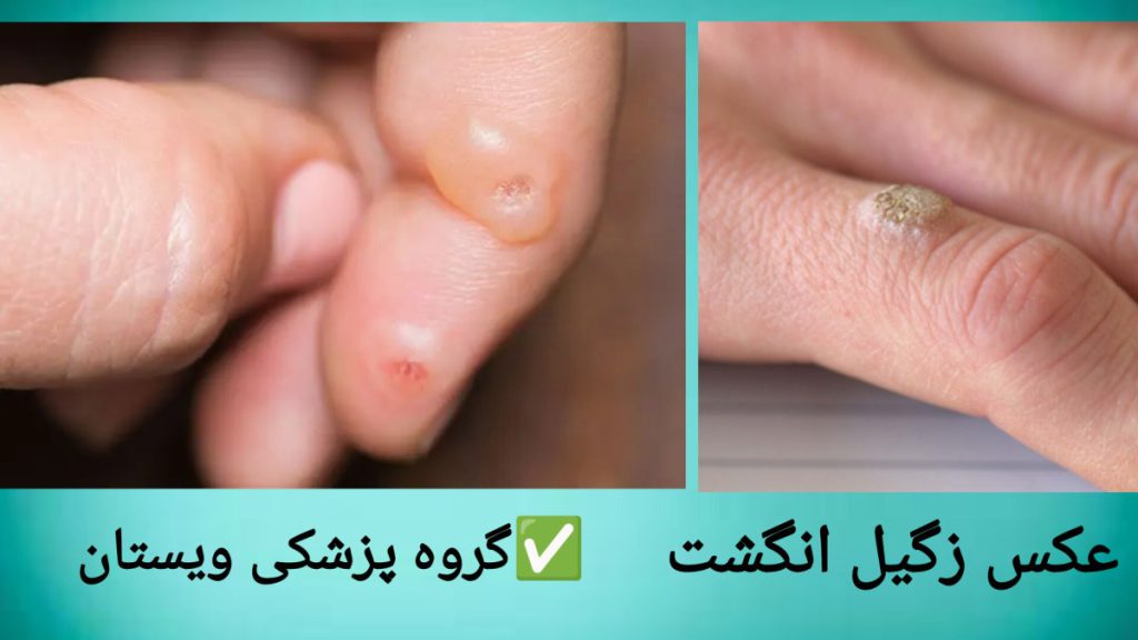 عکس هایی از زگیل روی انگشت دست بیمار نمایی از زگیل روی دست