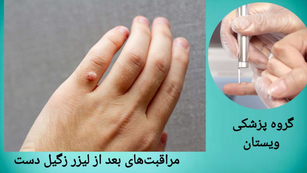 پزشک در حال انجام لیزر زگیل دست برای بیمار