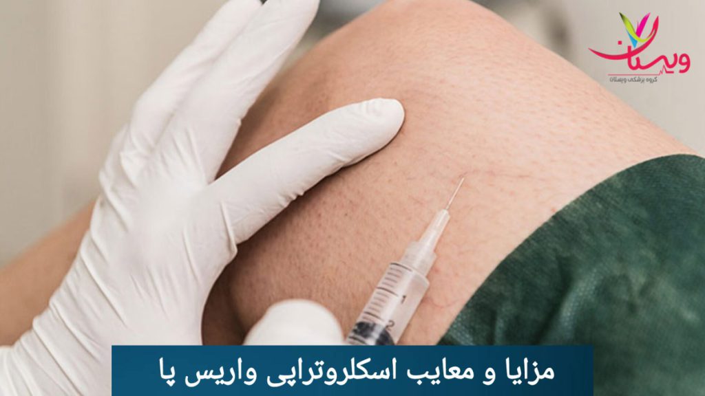 انجام اسکلروتراپی و بررسی مزایا و معایب آن بررسی مزایا و معایب انجام اسکلروتراپی