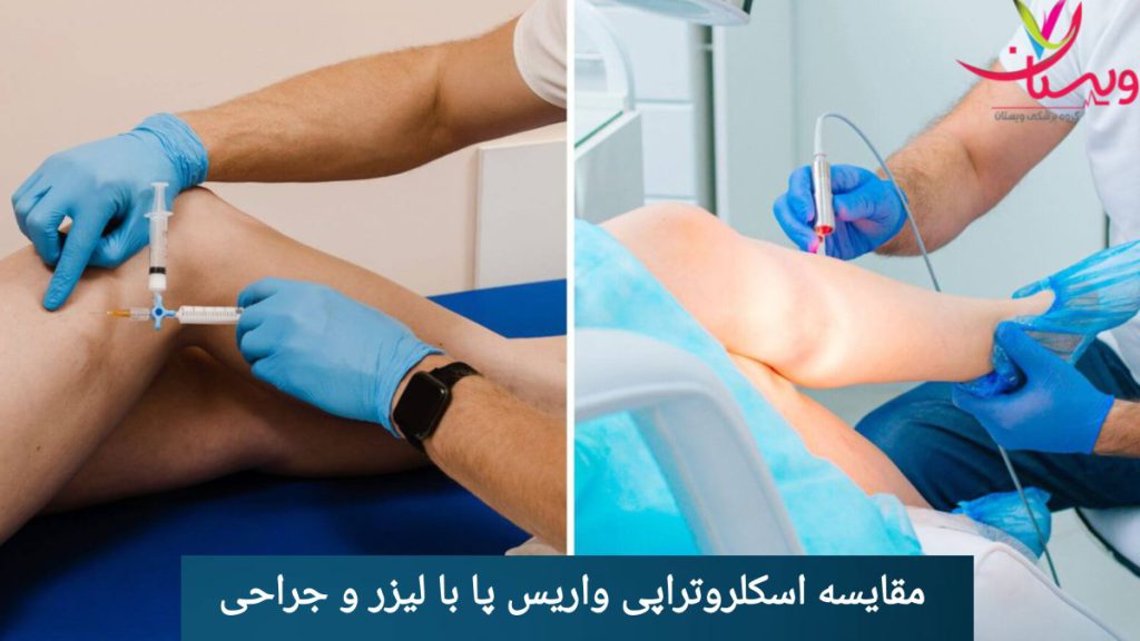 در تصویر درمان واریس پا با اسکلروتراپی و با لیزر مقایسه شده است. نمایی از درمان واریس پا با اسکلروتراپی و درمان با لیزر