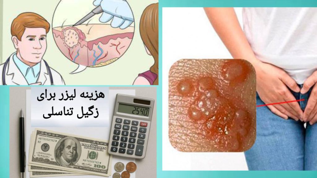 برداشتن زگیل تناسلی توسط پزشک خانمی دچار زگیل تناسلی شده است و برداشتن زگیل تناسلی با لیزر