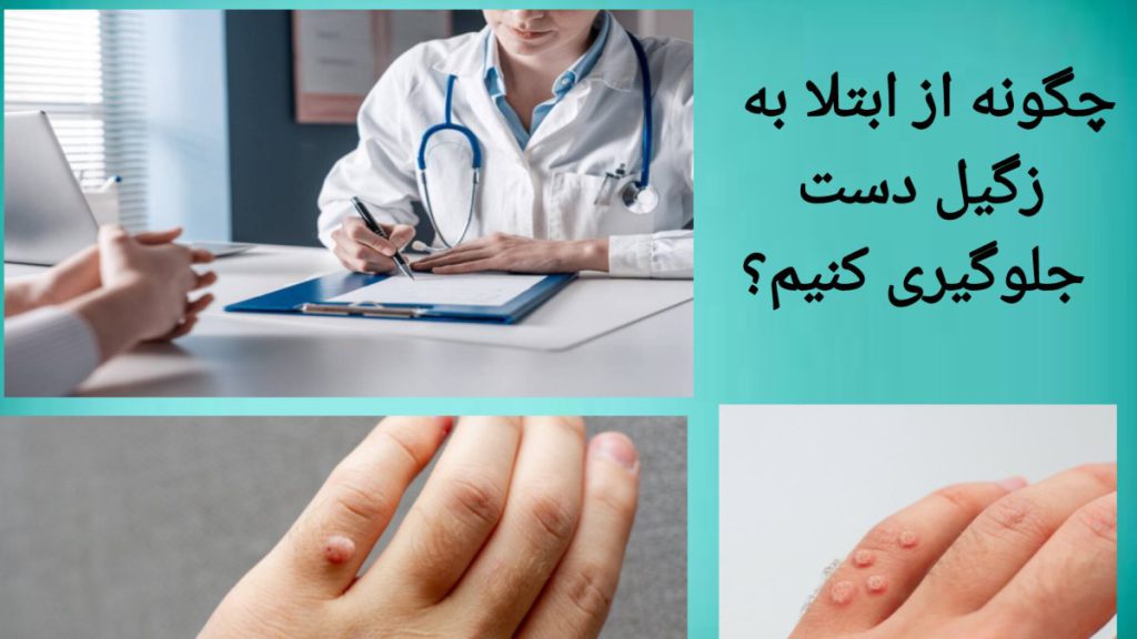 درمان زگیل دست با مراجعه به پزشک فرد برای درمان زگیل دست به پزشک مراجعه کرده است.