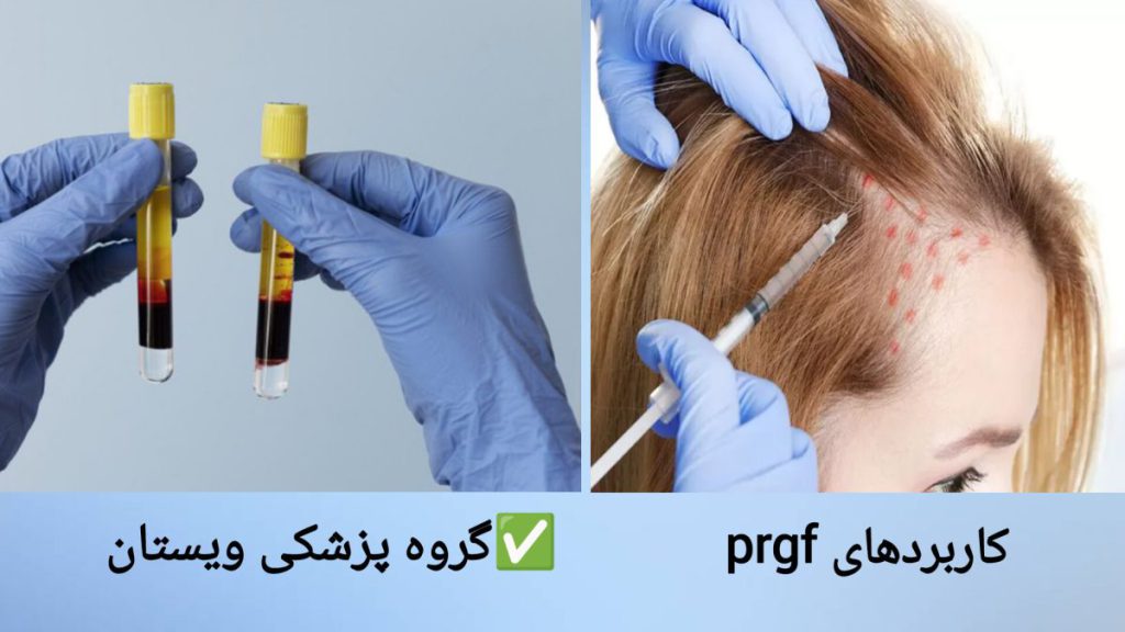 تزریق prgf به سر بیمار پزشک در حال تزریق prgf به قسمتی از سر بیمار